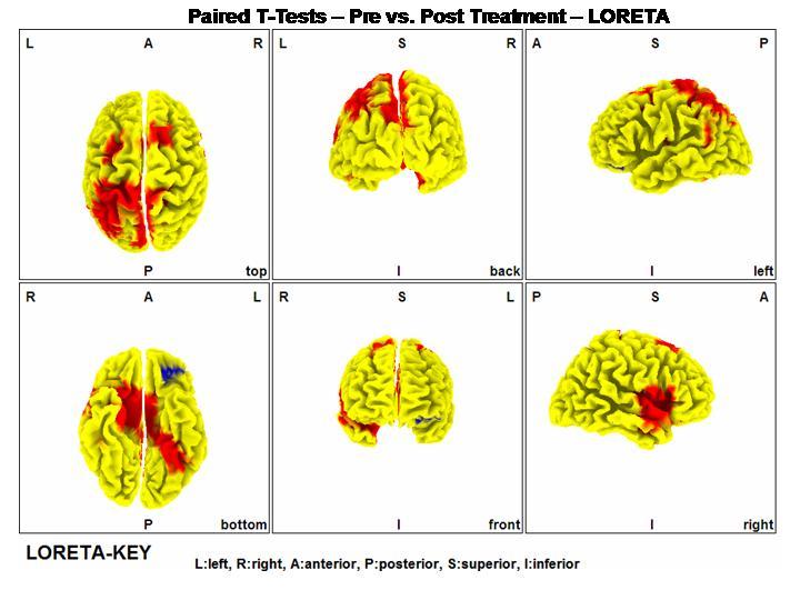 Neurostat Patterns NeuroStat – NeXus | NSET Mind Media